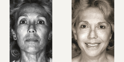 Case 9796 - Woman treated with Laser Resurfacing