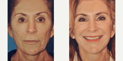 Case 9797 - Woman treated with Laser Resurfacing