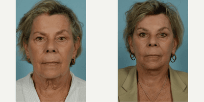 Case 9818 - 65-74 year old woman treated with Facelift, SMAS Facelift, Neck Lift, Eyelid Surgery, Brow Lift, Facial Fat Transfer, Laser Resu