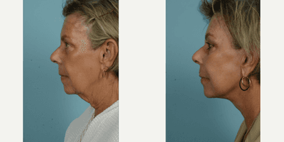 Case 9819 - 65-74 year old woman treated with Facelift, SMAS Facelift, Neck Lift, Eyelid Surgery, Brow Lift, Facial Fat Transfer, Laser Resu