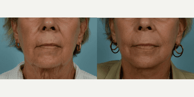 Case 9820 - 65-74 year old woman treated with Facelift, SMAS Facelift, Neck Lift, Eyelid Surgery, Brow Lift, Facial Fat Transfer, Laser Resu