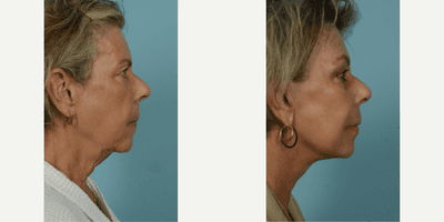 Case 9821 - 65-74 year old woman treated with Facelift, SMAS Facelift, Neck Lift, Eyelid Surgery, Brow Lift, Facial Fat Transfer, Laser Resu