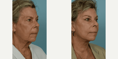 Case 9822 - 65-74 year old woman treated with Facelift, SMAS Facelift, Neck Lift, Eyelid Surgery, Brow Lift, Facial Fat Transfer, Laser Resu