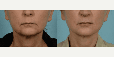 Case 9824 - 45-54 year old woman treated with Facelift, Lower Facelift, Neck Lift, Facial Fat Transfer, Laser Resurfacing, Dermabrasion
