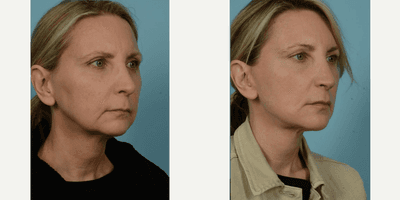 Case 9825 - 45-54 year old woman treated with Facelift, Lower Facelift, Neck Lift, Facial Fat Transfer, Laser Resurfacing, Dermabrasion