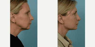 Case 9826 - 45-54 year old woman treated with Facelift, Lower Facelift, Neck Lift, Facial Fat Transfer, Laser Resurfacing, Dermabrasion