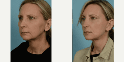 Case 9827 - 45-54 year old woman treated with Facelift, Lower Facelift, Neck Lift, Facial Fat Transfer, Laser Resurfacing, Dermabrasion