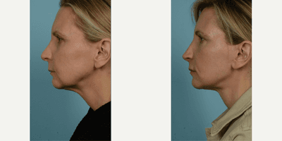 Case 9828 - 45-54 year old woman treated with Facelift, Lower Facelift, Neck Lift, Facial Fat Transfer, Laser Resurfacing, Dermabrasion