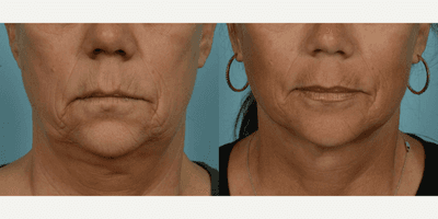 Case 9829 - 55-64 year old woman treated with Facelift, Lower Facelift, Neck Lift, Laser Resurfacing, Dermabrasion