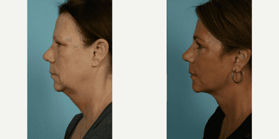 Case 9830 - 55-64 year old woman treated with Facelift, Lower Facelift, Neck Lift, Laser Resurfacing, Dermabrasion
