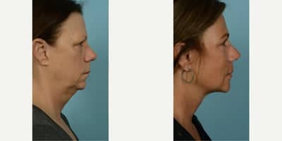 Case 9831 - 55-64 year old woman treated with Facelift, Lower Facelift, Neck Lift, Laser Resurfacing, Dermabrasion