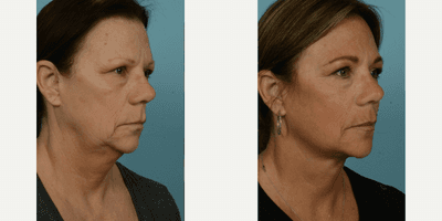 Case 9832 - 55-64 year old woman treated with Facelift, Lower Facelift, Neck Lift, Laser Resurfacing, Dermabrasion