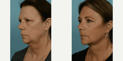 Case 9833 - 55-64 year old woman treated with Facelift, Lower Facelift, Neck Lift, Laser Resurfacing, Dermabrasion