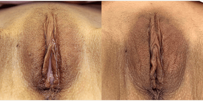 Case 9909 - 35-44 year old woman treated with Labiaplasty