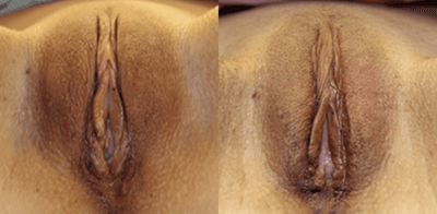 Case 9910 - 35-44 year old woman treated with Labiaplasty