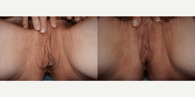 Case 9914 - 57 yo had Labiaplasty of minora & majora,Clitoral Hood Reduction w/Clitoropexy,PRP to surgical Wound