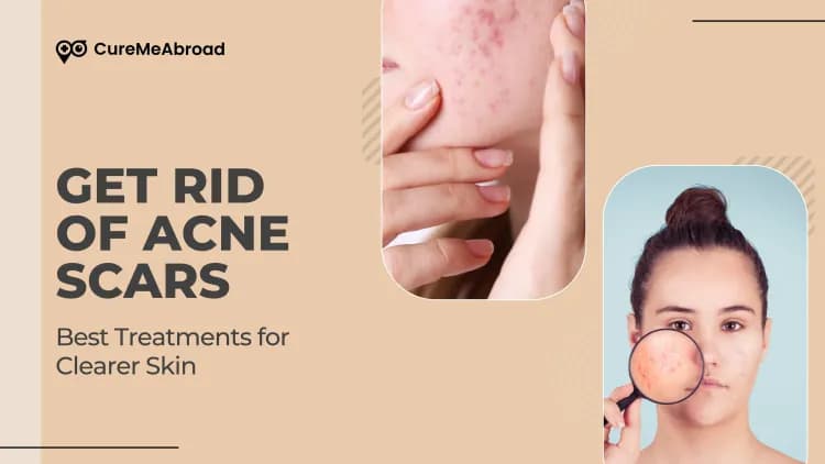 How to Get Rid of Acne Scars: Best Treatments for Clearer Skin