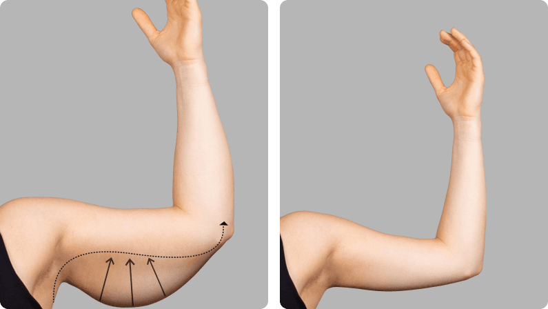 Arm Lift before and after
