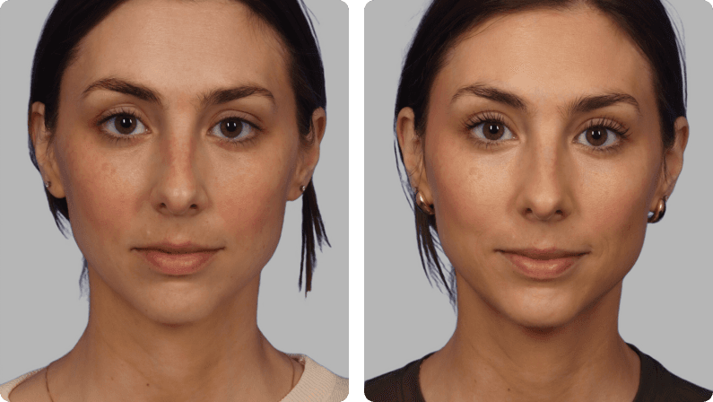 Botox before and after