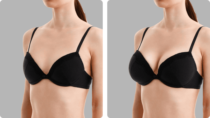 Breast Implants before and after