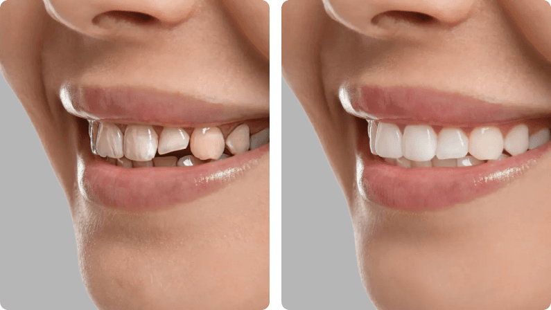 Dental Bonding before and after