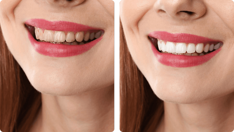 Dental Crowns before and after