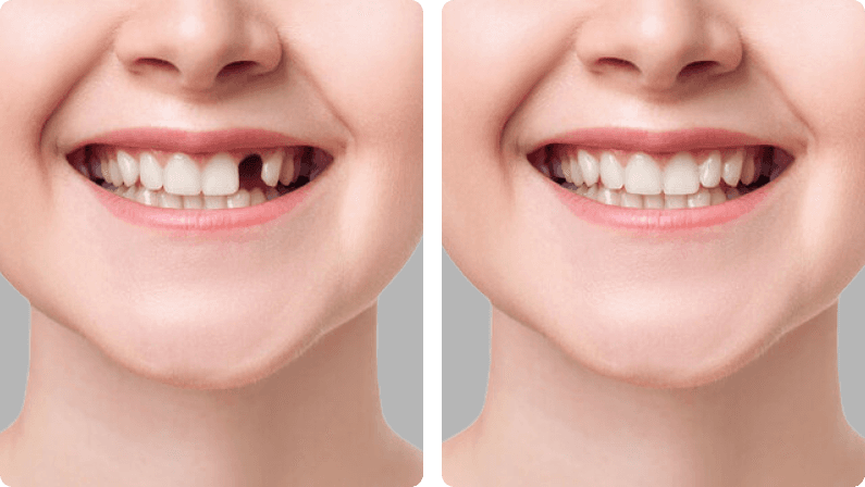 Dental Implants before and after