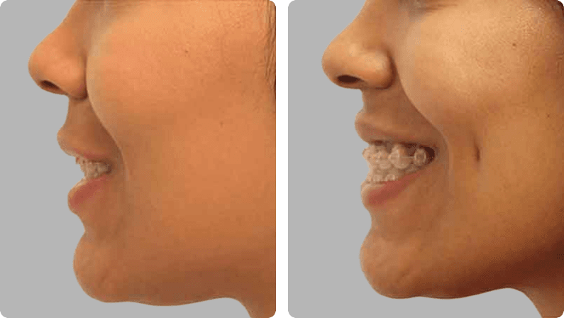 Dimple Creation before and after