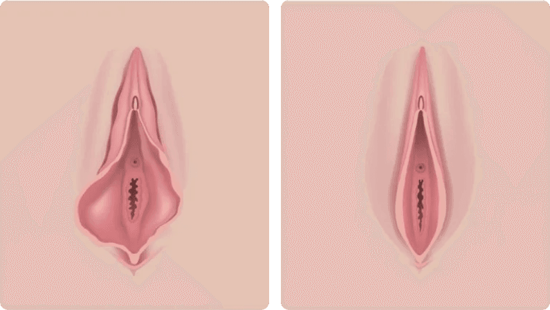 Labiaplasty before and after