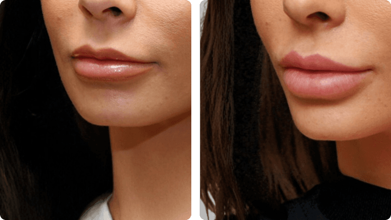 Lip Implant before and after