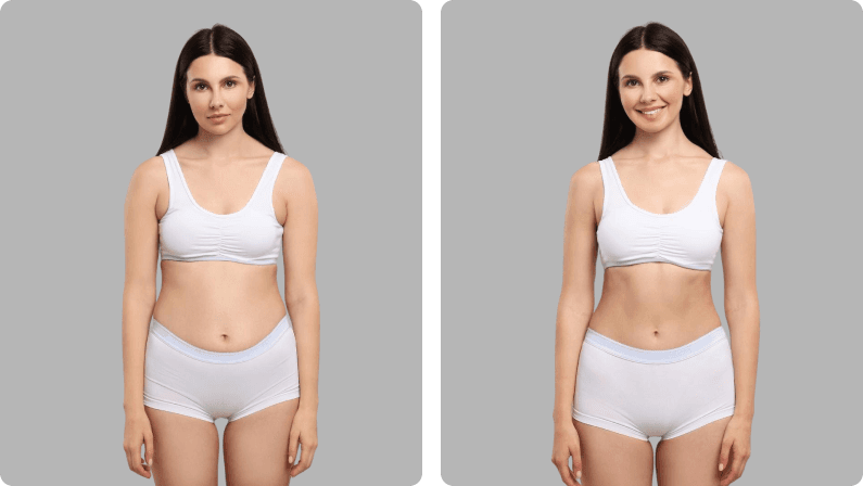 Liposculpture before and after