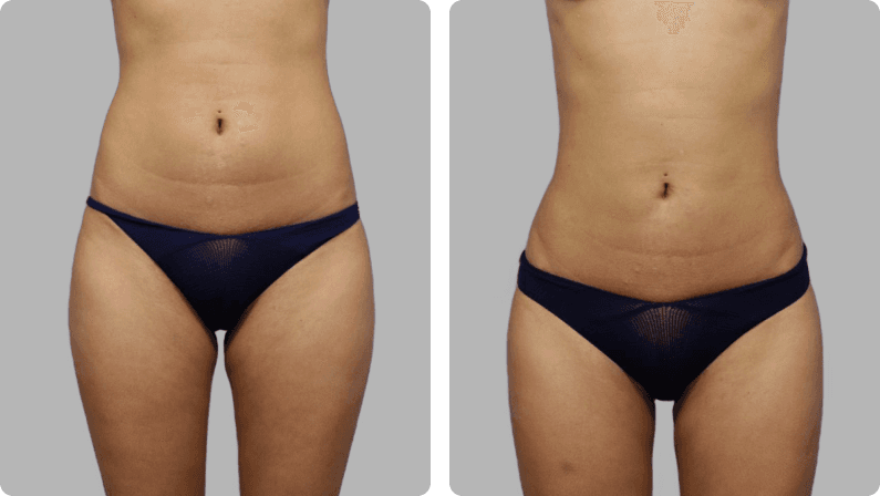 Liposuction before and after