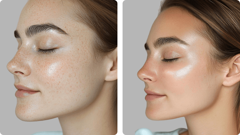 Microneedling before and after