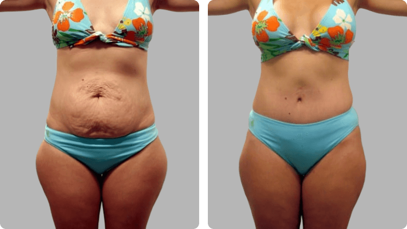 Mommy Makeover before and after