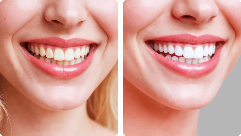 Teeth Whitening before and after