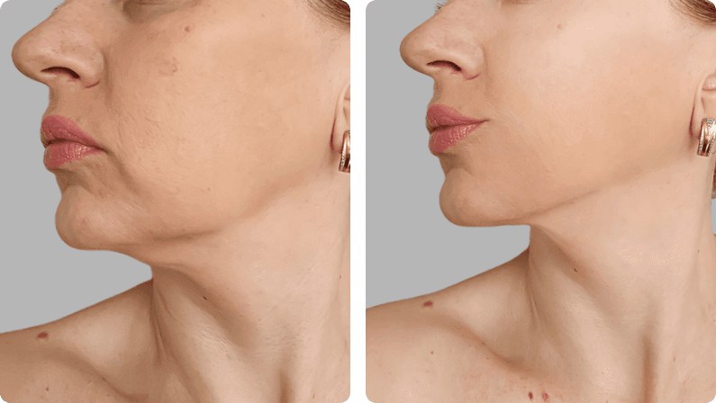 Thread Lift before and after