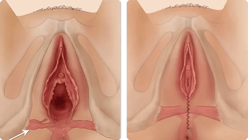 Vaginoplasty before and after