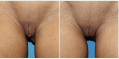 Case 10029 - Woman treated with Labiaplasty