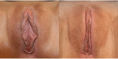 Case 10030 - Woman treated with Labiaplasty