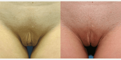 Case 10031 - Woman treated with Labiaplasty