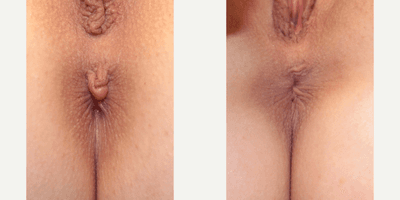 Case 10034 - Woman treated with Labiaplasty