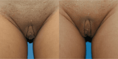 Case 10035 - Woman treated with Labiaplasty