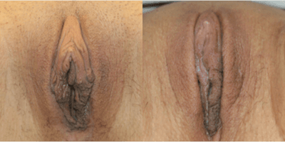 Case 10037 - Woman treated with Labiaplasty