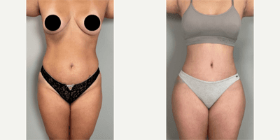 Case 1019 - Woman treated with Tummy Tuck