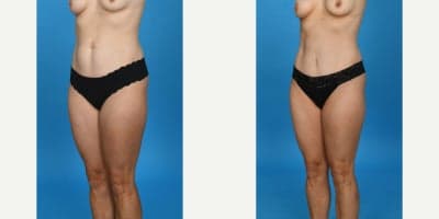 Case 10625 - 35-44 year old woman treated with Abdominal Etching, Diastasis Recti Repair, Drainless Tummy Tuck, Liposculpture, Liposuction, M