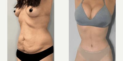 Case 1073 - Woman treated with Tummy Tuck