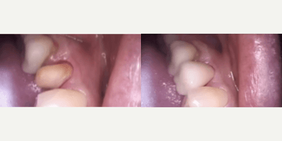 Case 10737 - Patient treated with Dental Crown