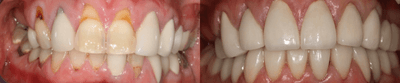 Case 10738 - 55-64 year old woman treated with Dental Crown