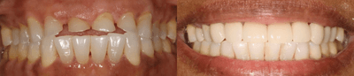 Case 10739 - 45-54 year old woman treated with Dental Crown