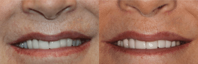 Case 10740 - 45-54 year old woman treated with Dental Crown